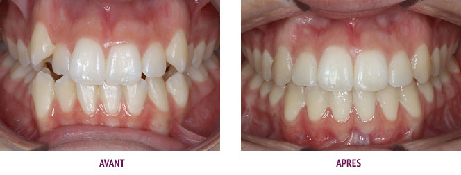 Traitement de malocclusions dentaires avec manque d'espace