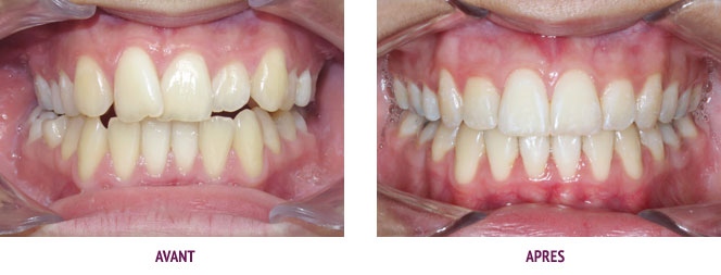 Les conséquences du non-remplacement des dents extraites ou absentes –  L'Information Dentaire