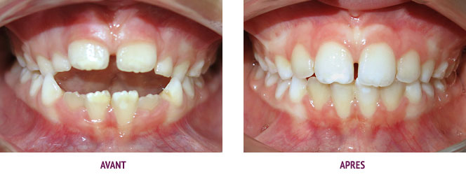 L'importance de la contention en orthodontie