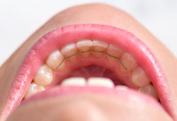 Orthodontie invisible Paris - Gouttières d'alignement des dents